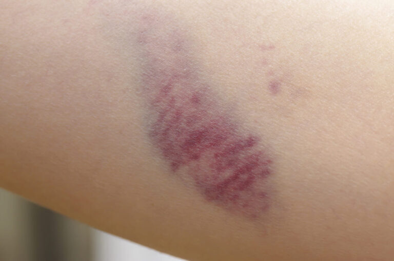 挫傷の治療はさいとう整骨院にお任せ。