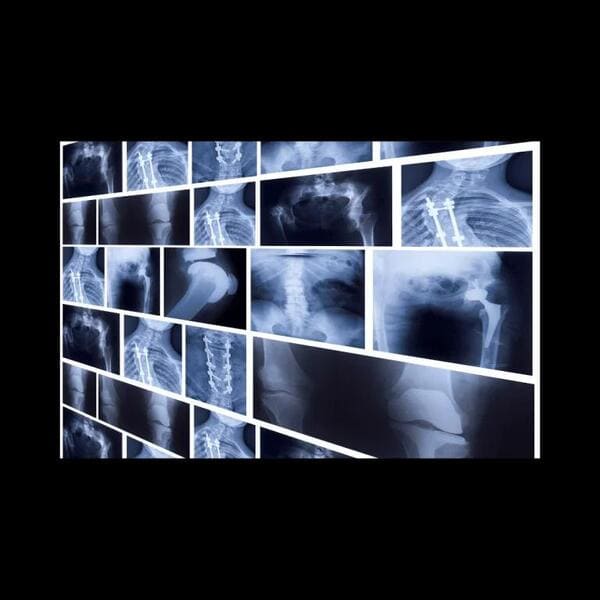 骨折したらさいとう整骨院の酸素カプセルがおすすめ。